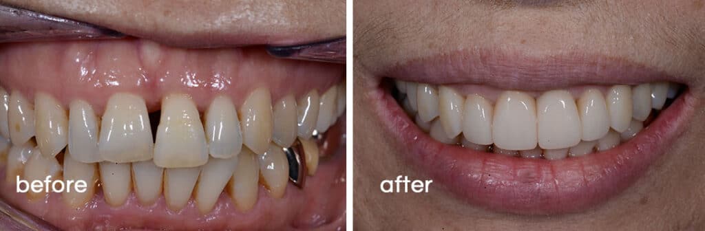 before and after pictures of dental treatments