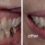 before and after pictures of dental treatments