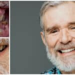 Senior male smiling with before and after results of dental treatment