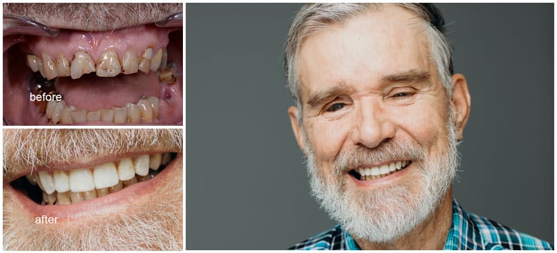 Senior male smiling with before and after results of dental treatment