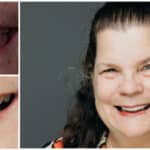 Lady smiling with before and after results from dental treatment