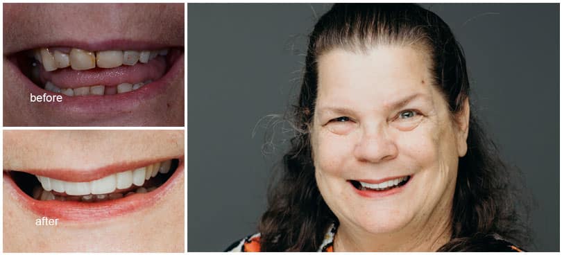 Lady smiling with before and after results from dental treatment