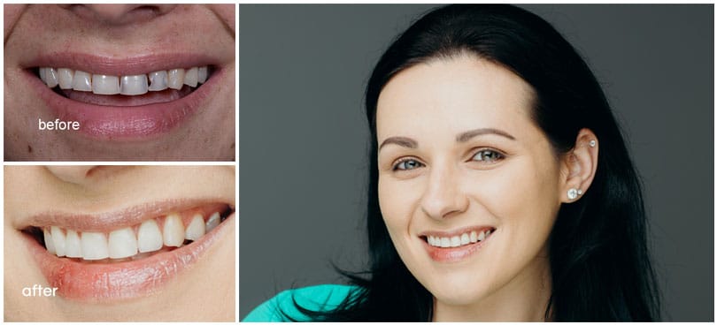 Young female smiling with before and after results of smile