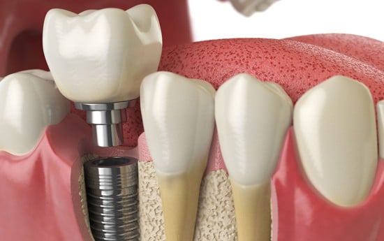 dental implants in Mansfield, tx under Dr. Jung DDS