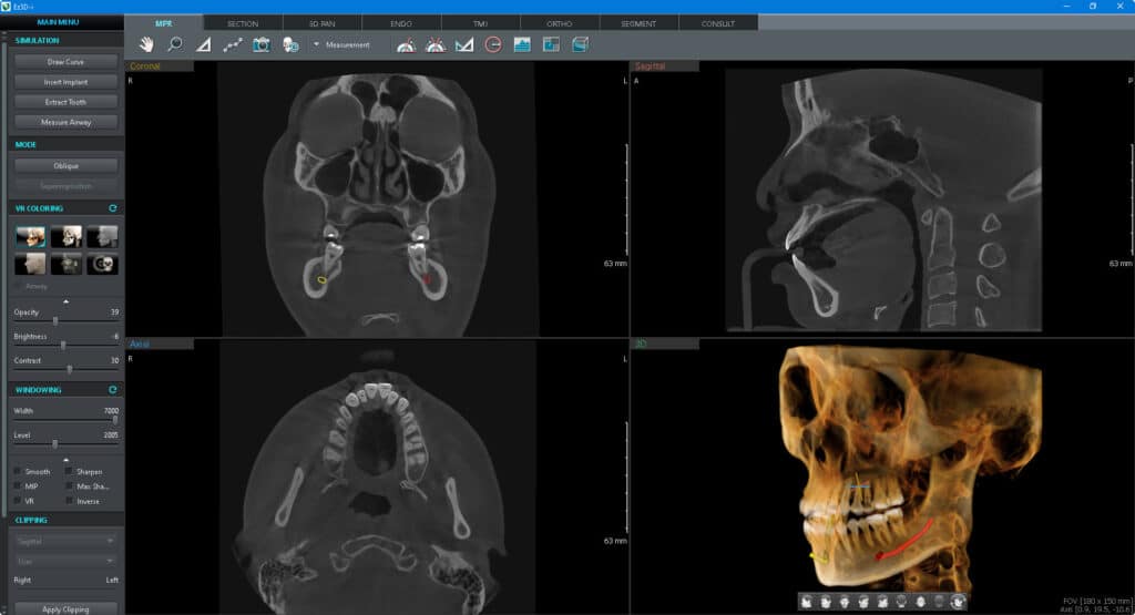 CBCT