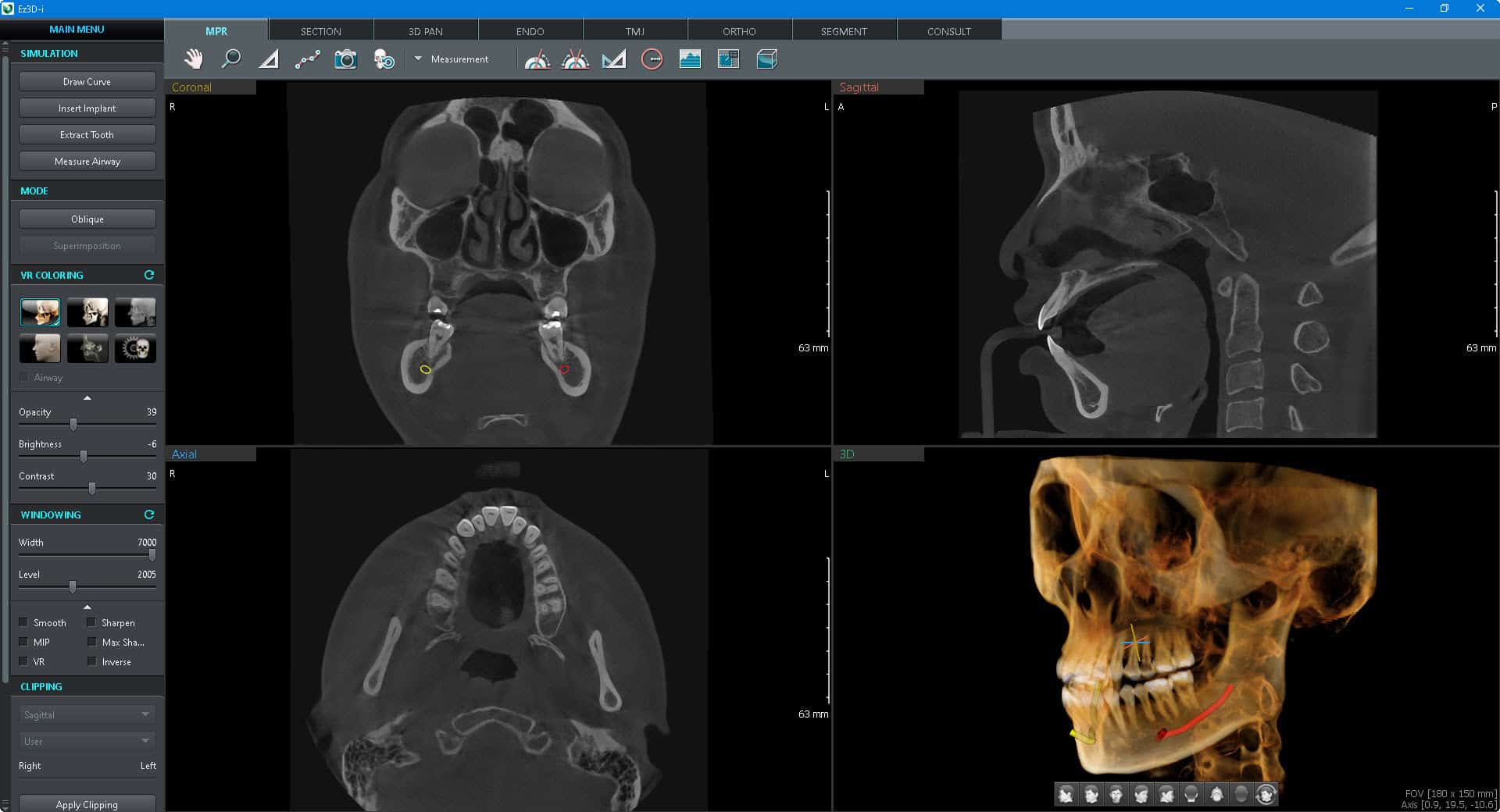 CBCT