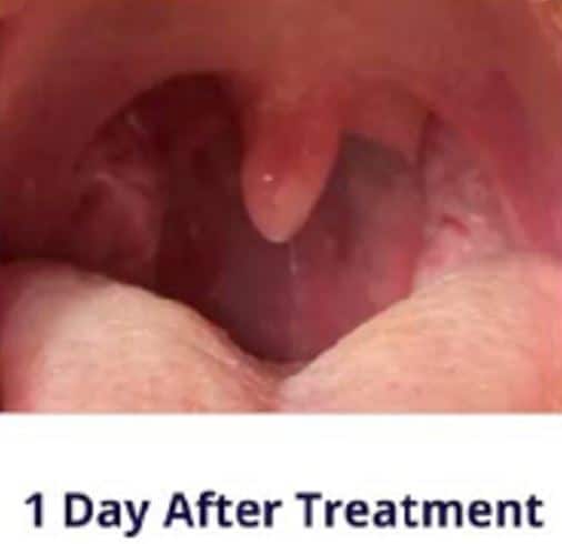 Laser treatment for sleep apnea
