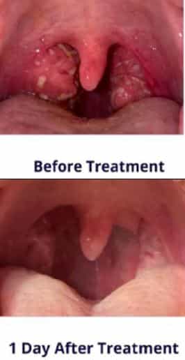 Laser Tonsile Treatment