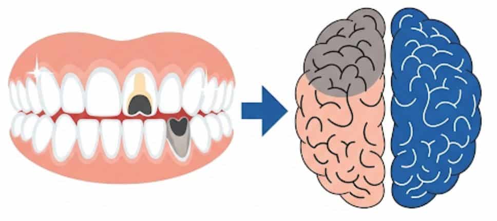 Tooth Loss and Dementia